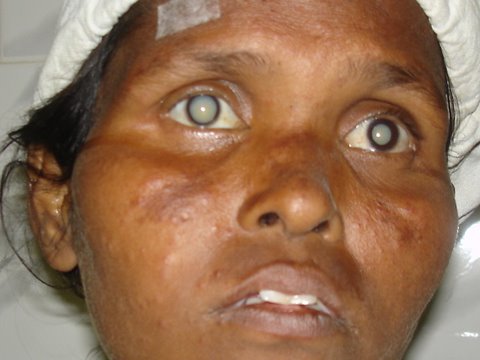 Blind--White cataract in both eyes
